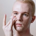 Scarred but Not for Life - Rid Your Face of Acne Scars