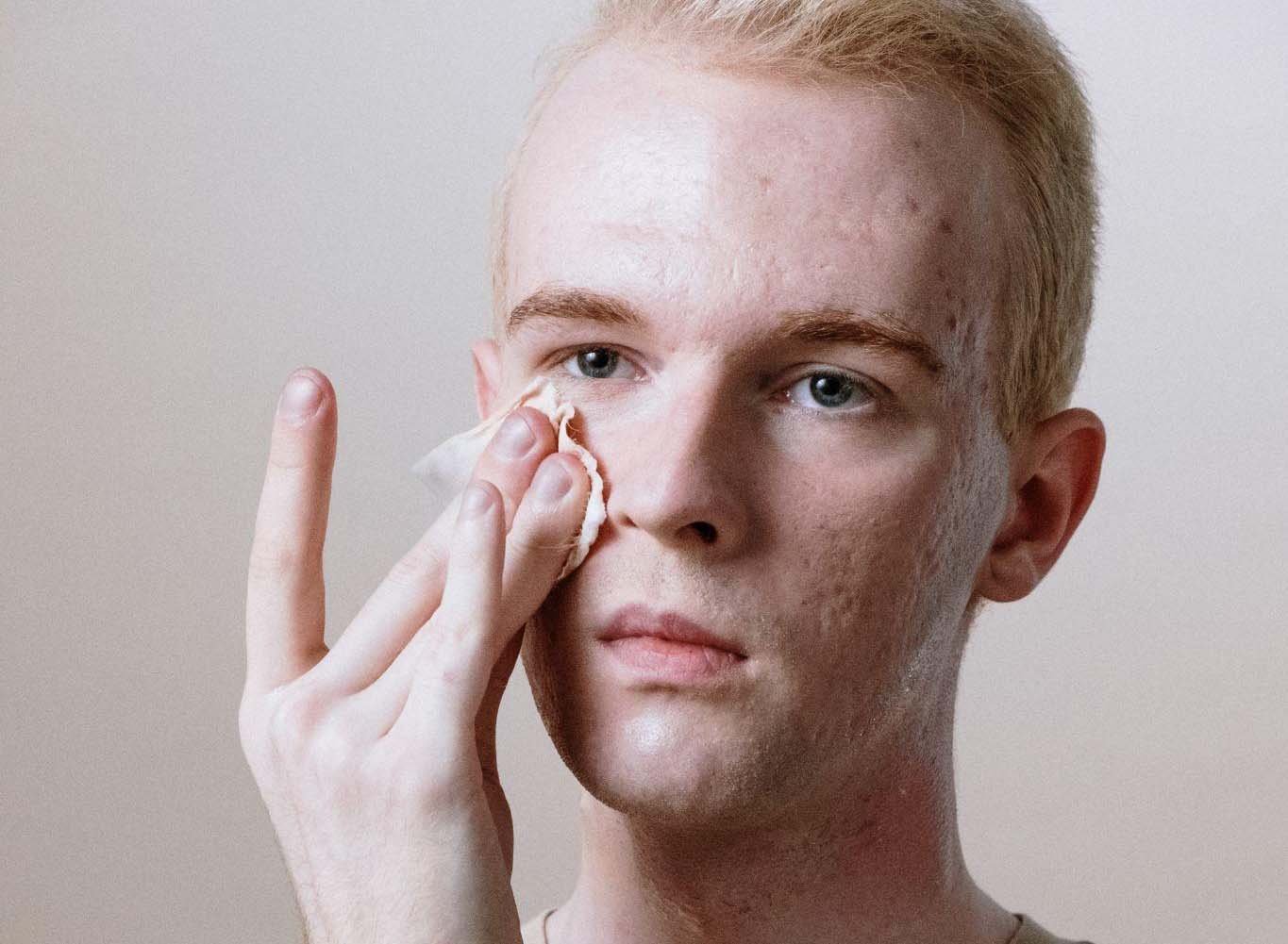 Scarred but Not for Life - Rid Your Face of Acne Scars