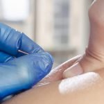 Benefits of Undergoing Dry Needling Physical Therapy