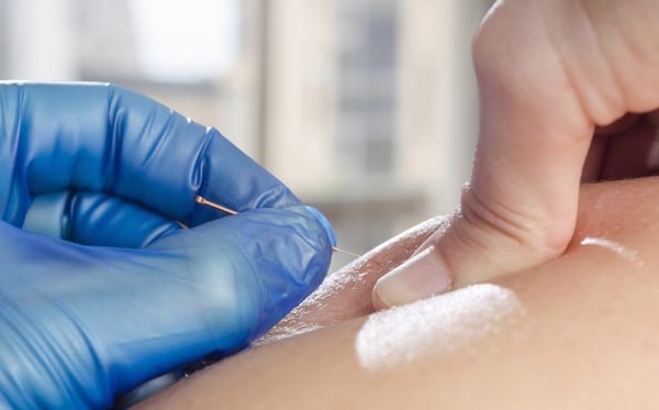 Benefits of Undergoing Dry Needling Physical Therapy