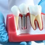 How Long Can You Expect Your Dental Implants to Last
