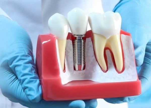 How Long Can You Expect Your Dental Implants to Last