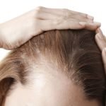 An Effective Solution for Alopecia