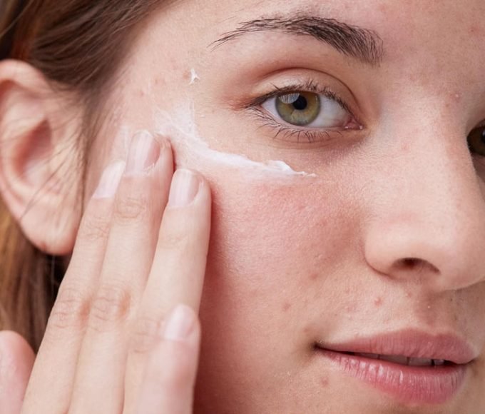 Are Eyelashes, Melasma, and Acne