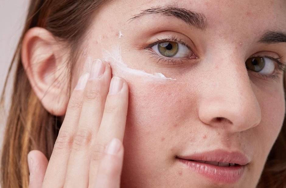 Are Eyelashes, Melasma, and Acne