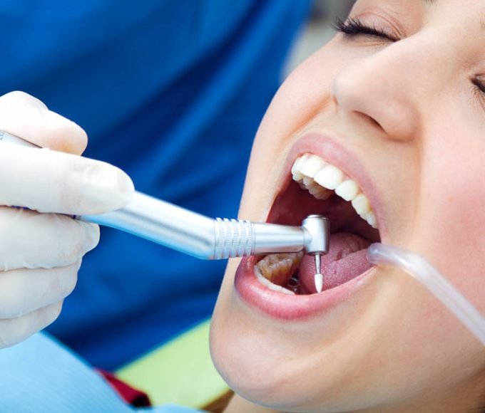Dental Fillings