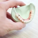 The Lifespan of Dental Implants