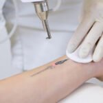 Laser Tattoo Removal
