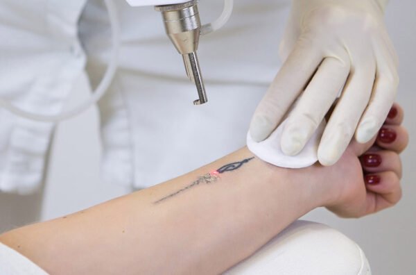Laser Tattoo Removal