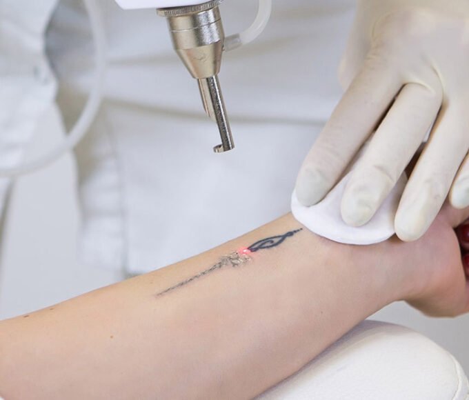 Laser Tattoo Removal