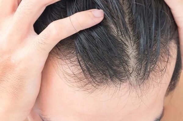 Treating the root cause of hair loss