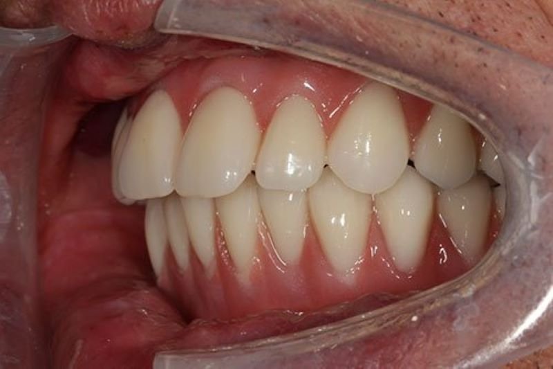 What is the Ideal Mewing Teeth Position