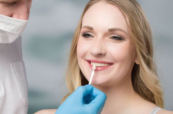 A Comprehensive Guide to Veneers