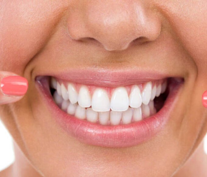 Whiten Cracked Teeth
