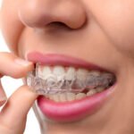 Clear Aligners in South Surrey