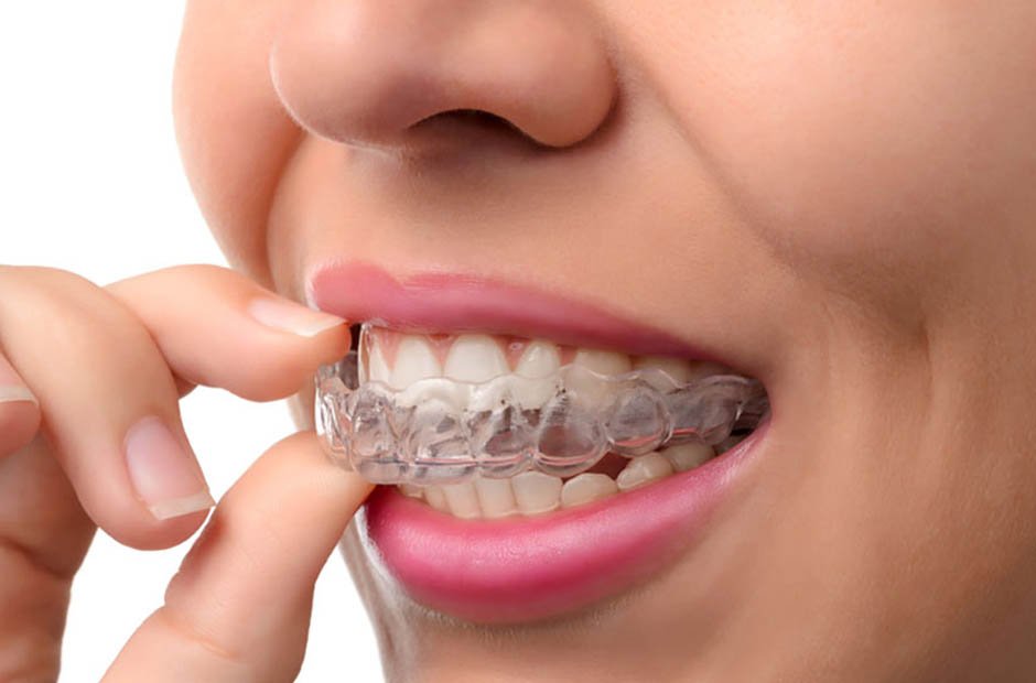 Clear Aligners in South Surrey