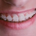 Clear Braces