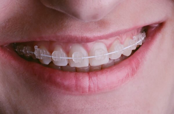 Clear Braces