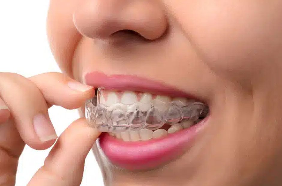 Orthodontics and Aesthetics