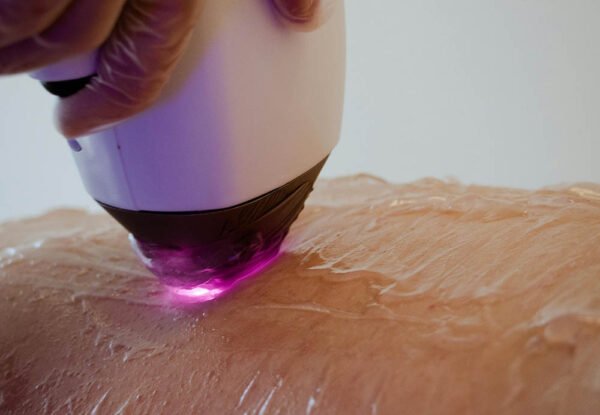 3 Things to Know About Laser Hair Removal