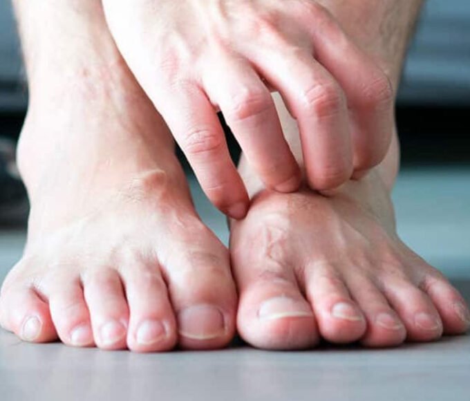 Wage War on Foot Fungus