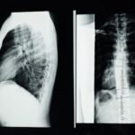 Understanding the Journey A Look at Spine Surgery