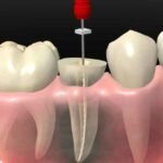 Understanding the Root Canal Process
