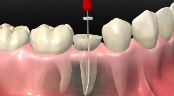 Understanding the Root Canal Process